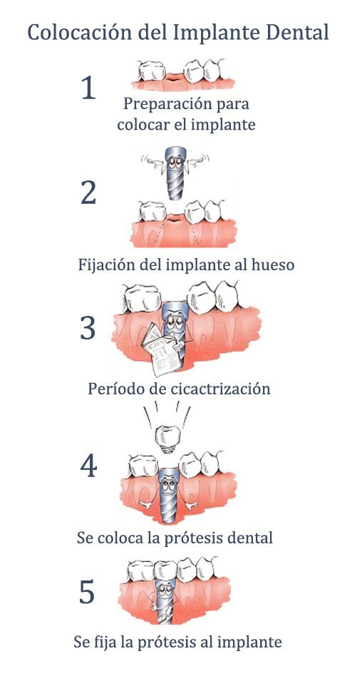 fases de los implantes dentales
