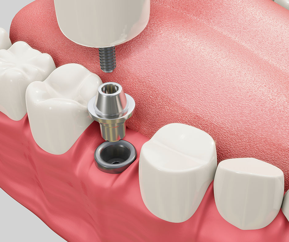 Implantes-baratos-que-salen-caros