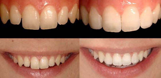 5 preguntas sobre el blanqueamiento dental 7 blanquemiento dental