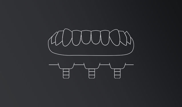 Protesis dental sobre implantes