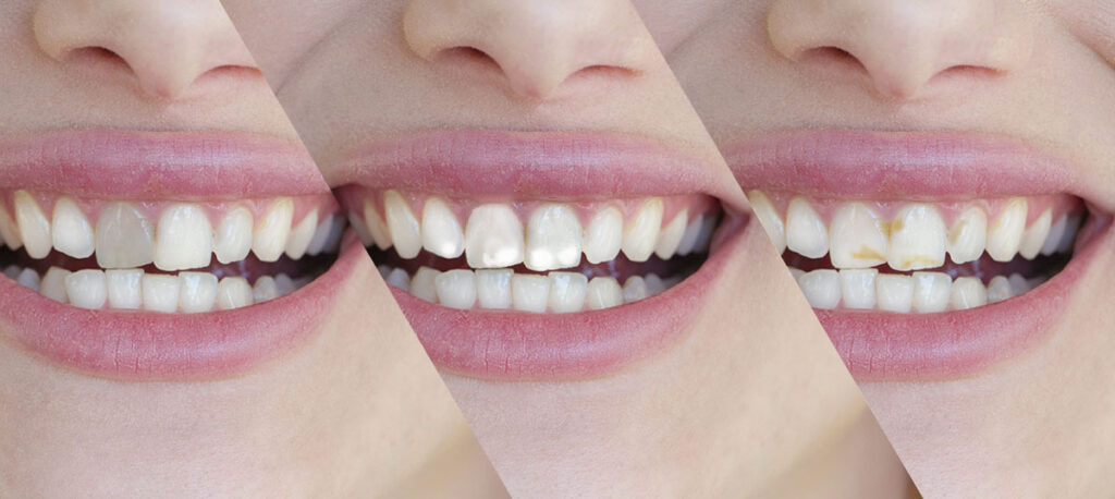 Manchas en los dientes