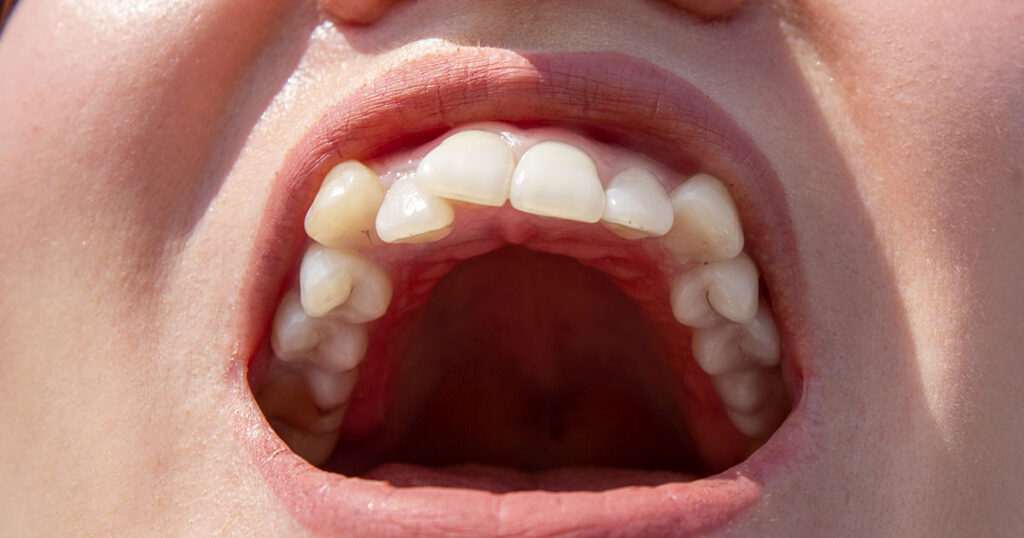 Apiñamiento dental