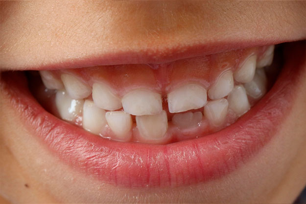 Tallado selectivo: qué es y cómo ayuda a prevenir maloclusiones dentales 3 tallado selectivo o ajuste oclusal
