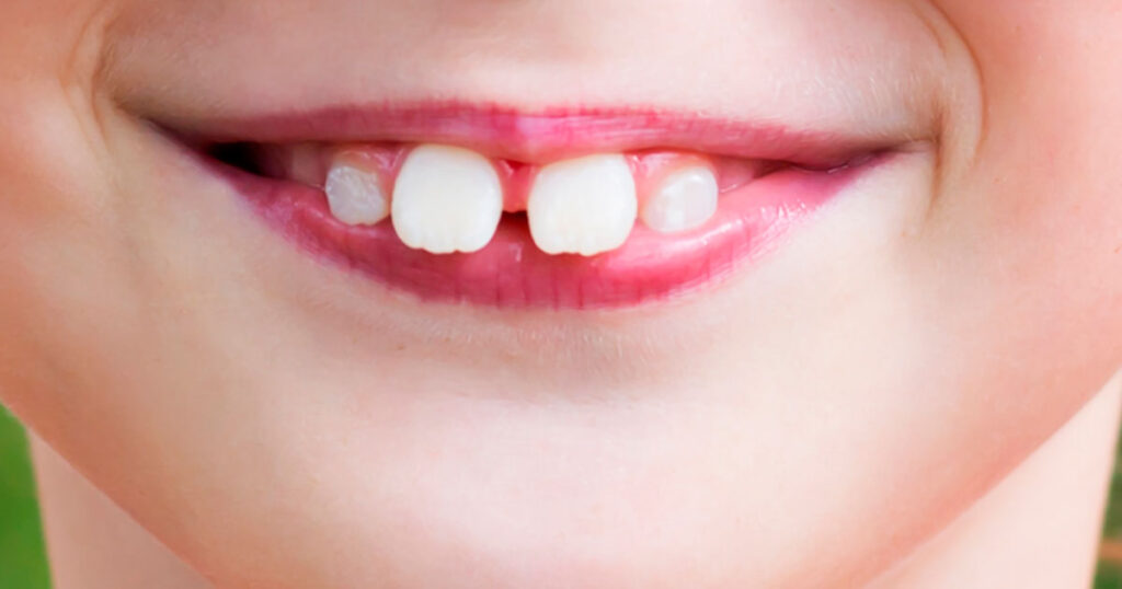 interposición labial