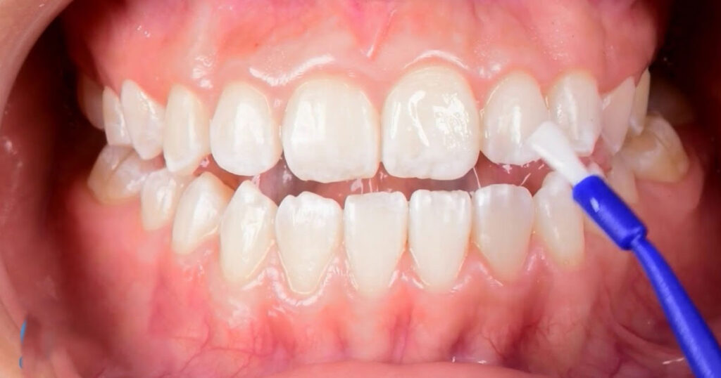 Fluorización dental: el escudo invisible para la sonrisa de tus hijos. 2 fluorización dental