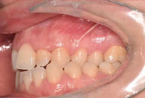 Mordida cruzada: Qué es, causas, riesgos y tratamiento 4 mordida cruzada 3