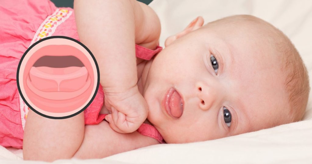 frenillo corto lingual