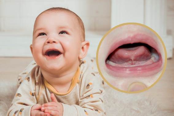 frenillo corto lingual en bebes