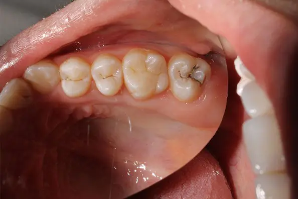 caries dental en muela