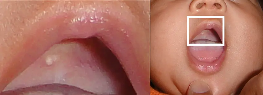 Perlas de Epstein en bebés