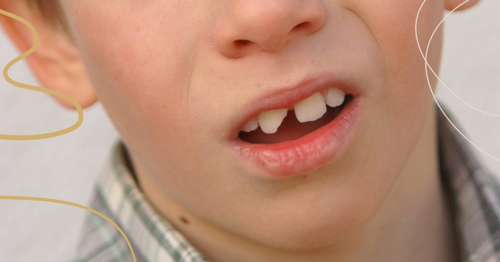 Qué debes hacer si sufres una fractura dental para salvar tu diente 1 diente roto