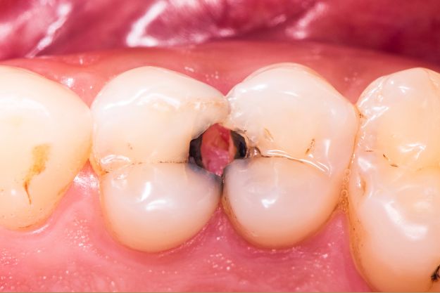 Caries interproximales: Así actuan las caries entre los dientes 3 Interproximales post