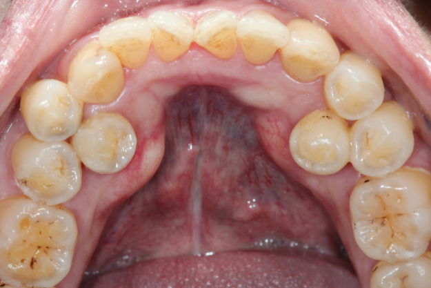 Dientes supernumerarios