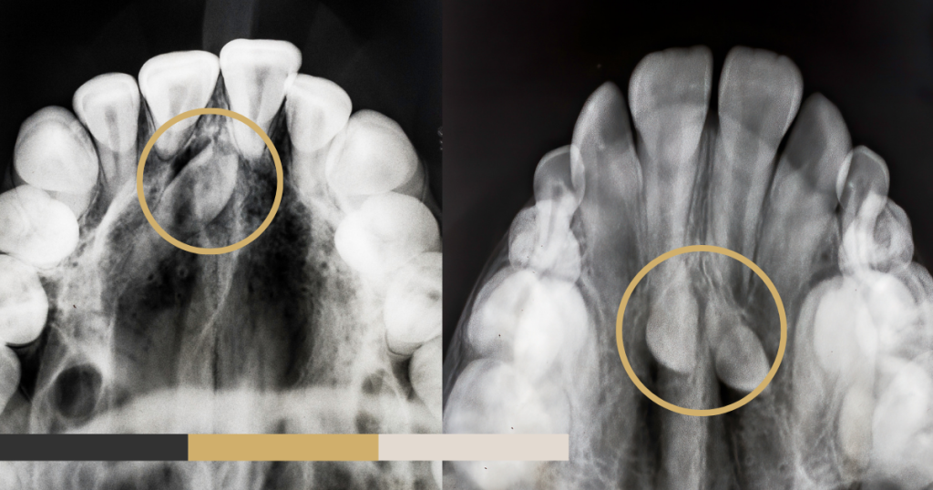 Dientes supernumerarios: qué son, por qué aparecen y qué hacer si los tienes 1 Dientes supernumerarios